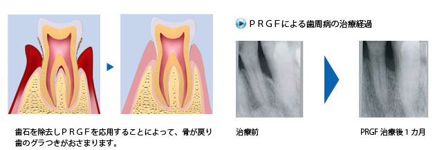 PRGFによる歯周病治療