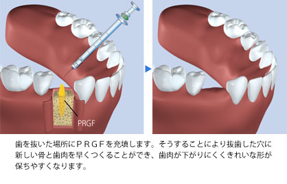 PRGFによる抜歯後の骨・歯肉の再生